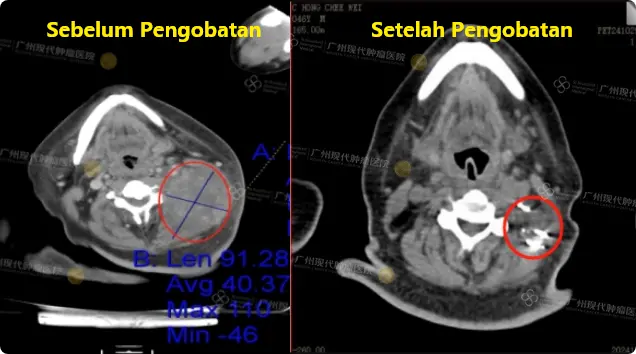 CT3