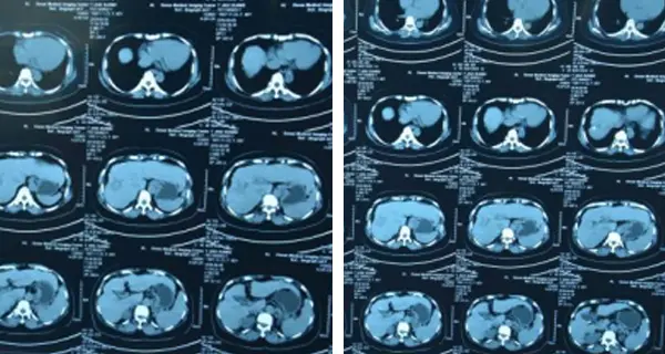 Pasien dengan tumor kambuh